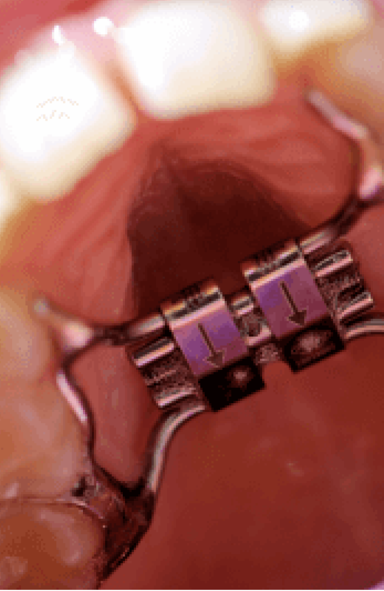 Palatal Expansion Vancouver
