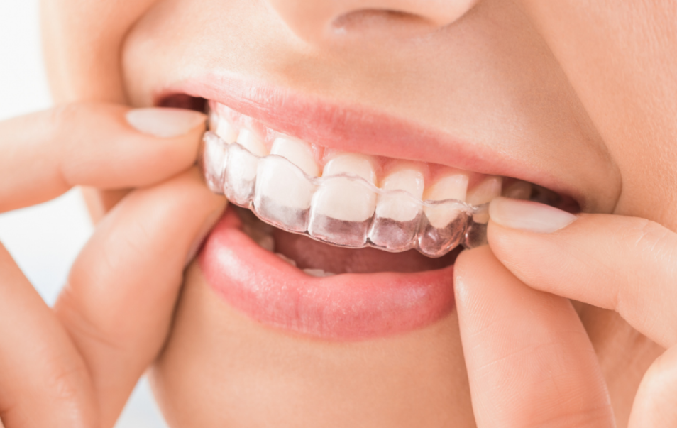 Invisalign Downtown Vancouver